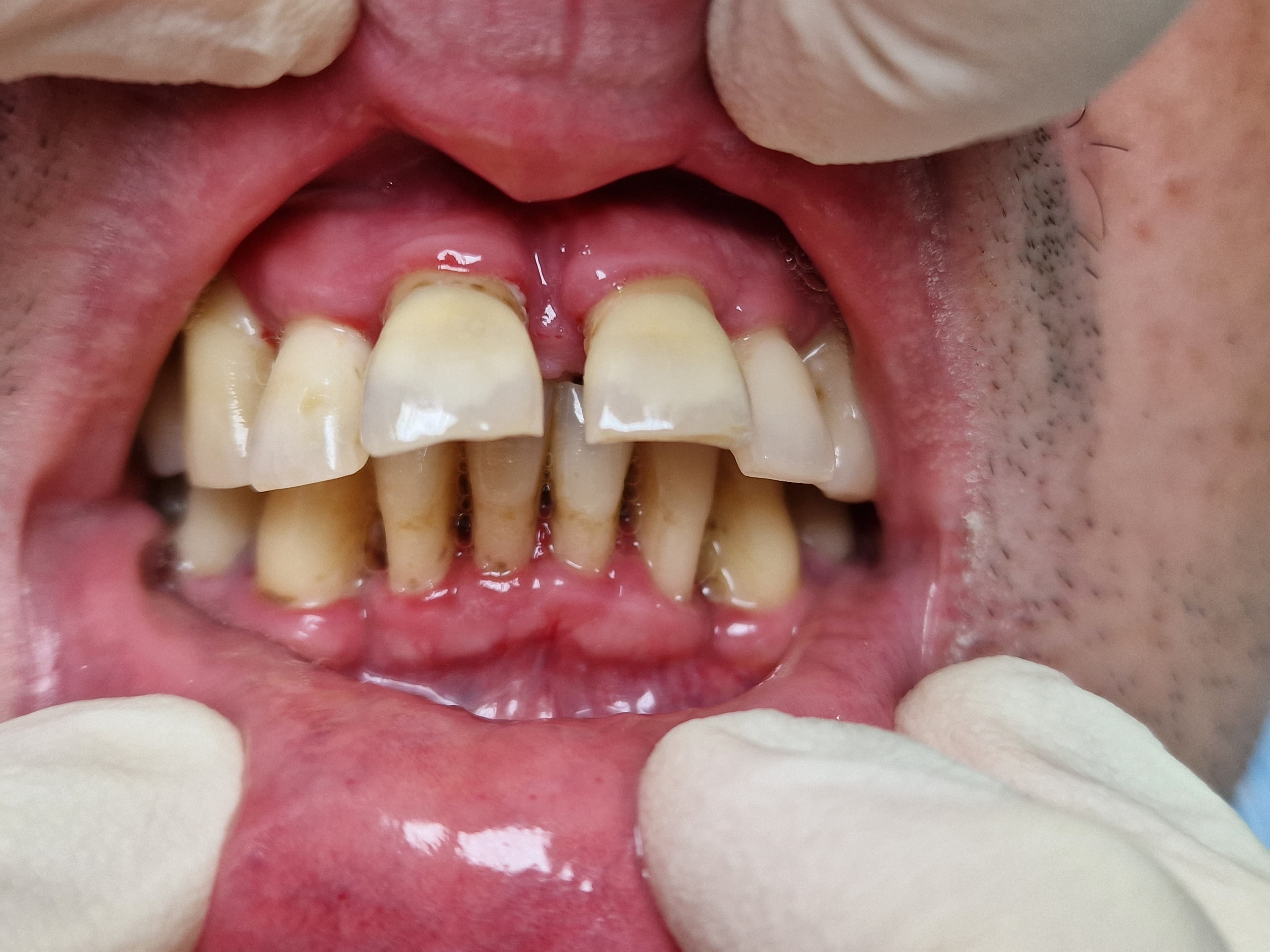 Felső front fogak cirkón koronák - frontal nézet - 1