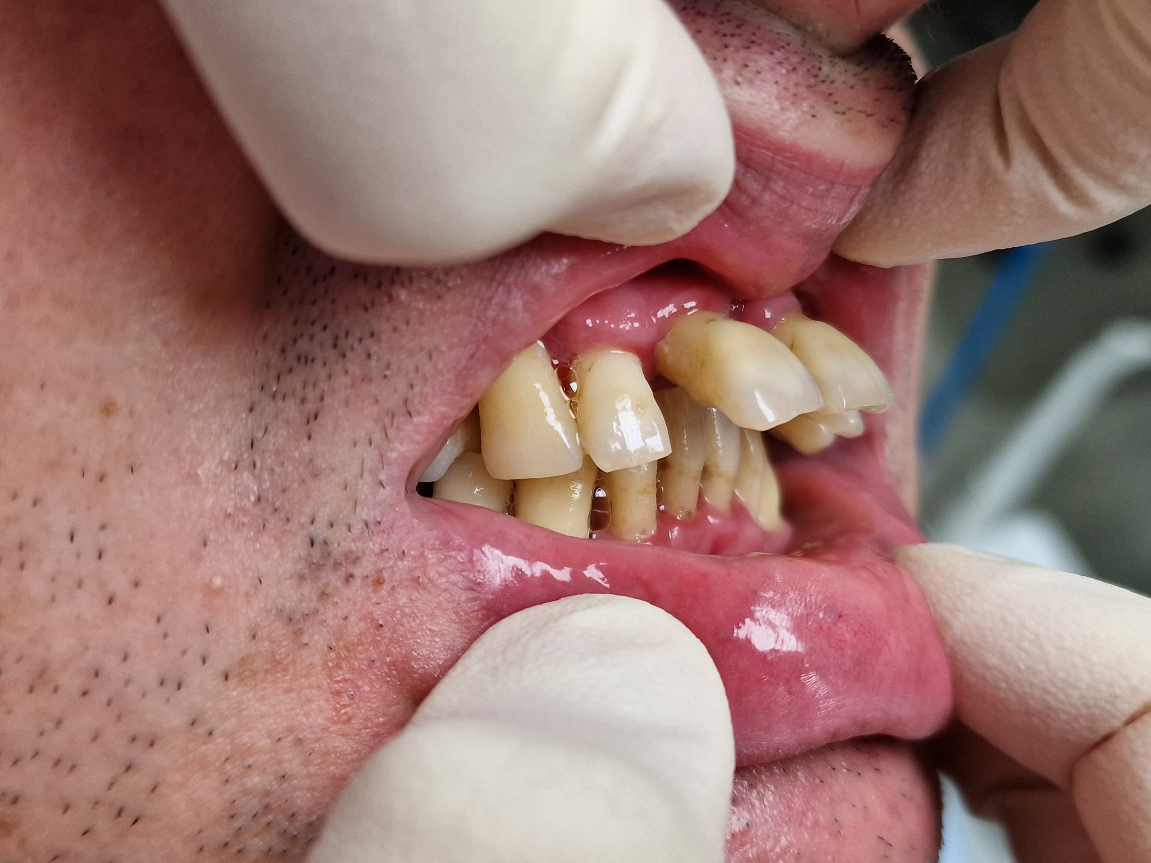 Felső front fogak cirkón koronák - oldalnézet - 1