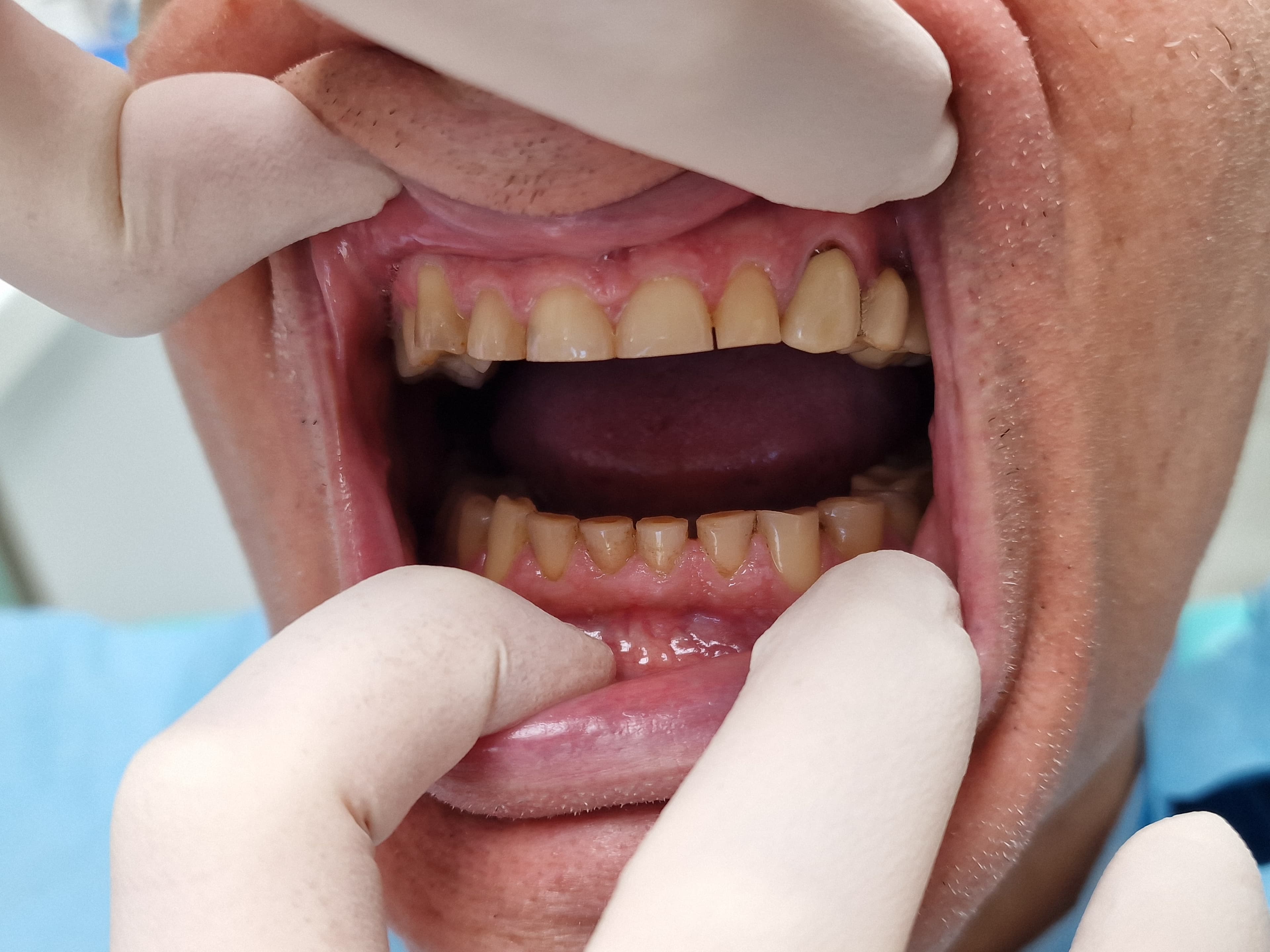 Teljes fogsor rehabilitáció - 1