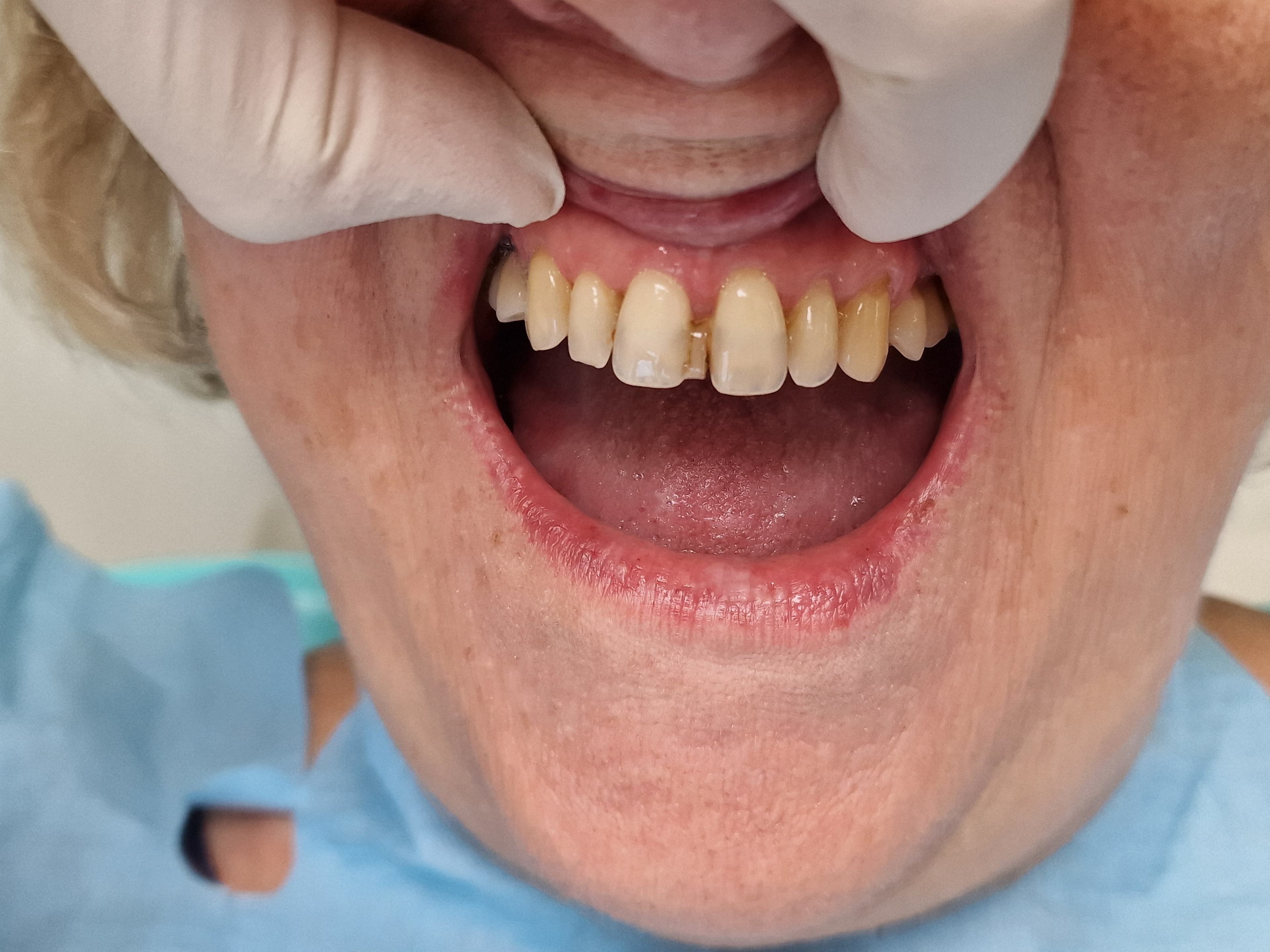 Felső front fogak esztétikai helyreállítása - 1