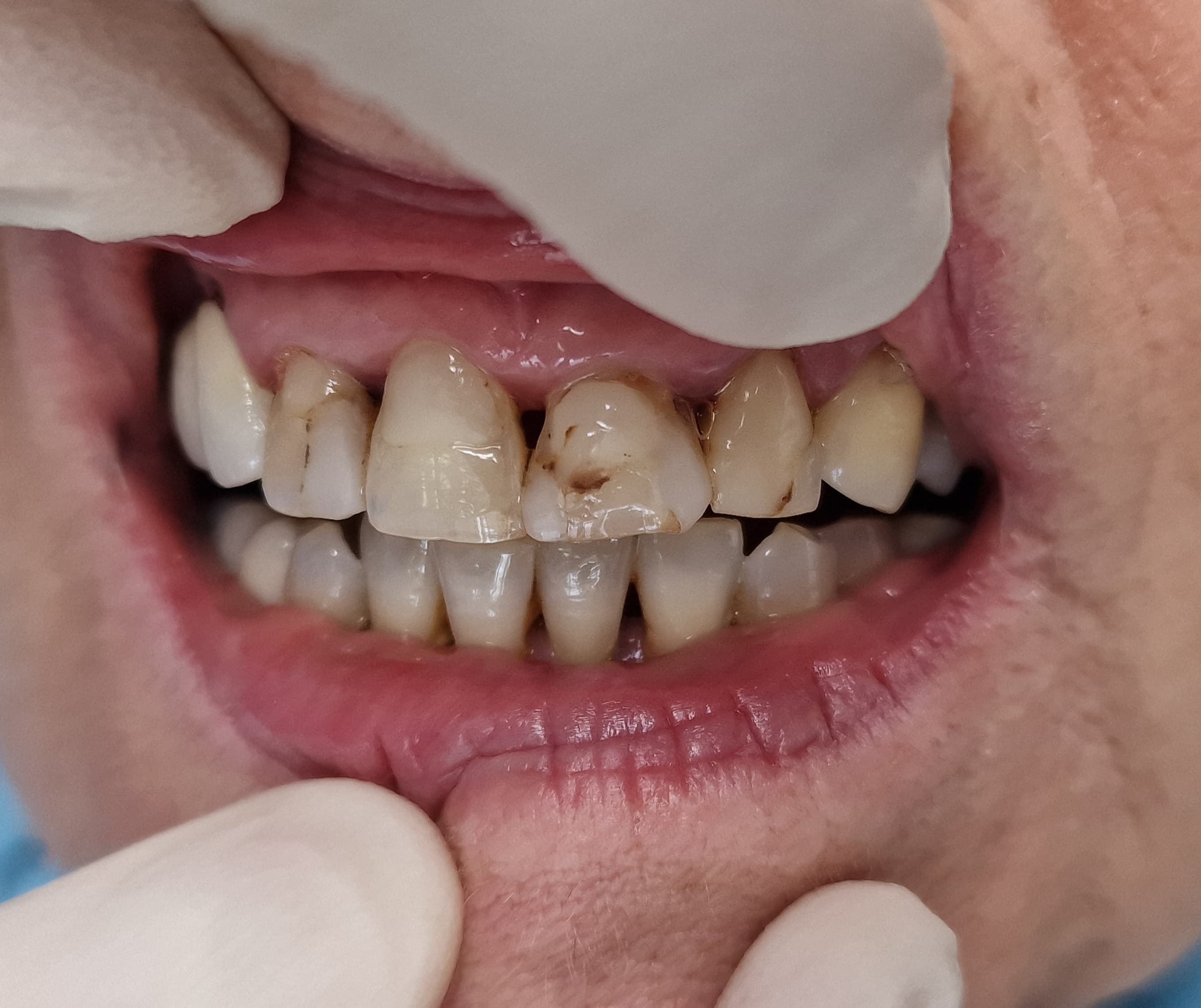 Kopott fogak helyreállítása - 1