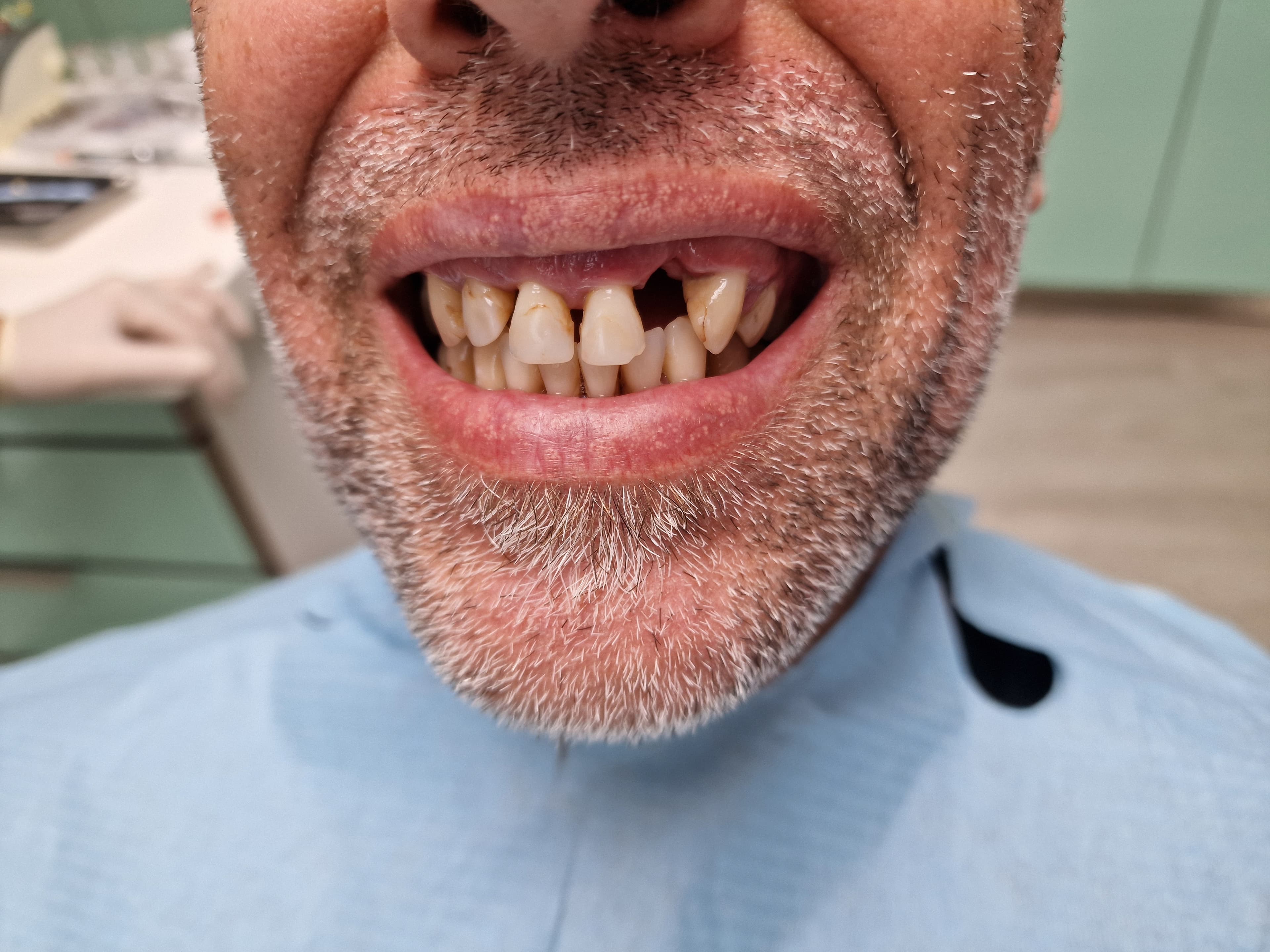 Hiányos fogsor pótlása - 1