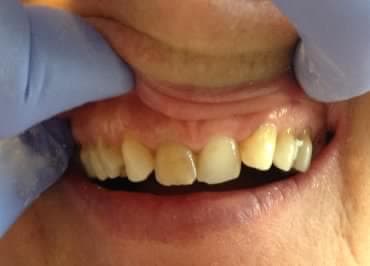 Fronthéj készítés - 1