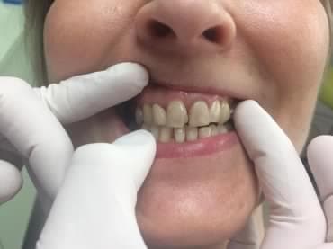 Cirkónium korona - 1