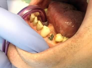 Implantációs fogpótlás - 1